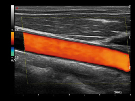 Клиническое изображение – MyLab™Alpha – сонная артерия (технология HD CFM)
