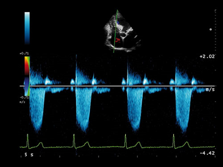 Клиническое изображение – MyLab™Alpha – сердце (CW Doppler)