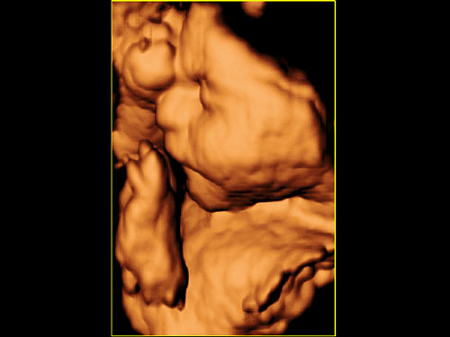 Клиническое изображение – MyLab™40 – синдром лица плода (4D визуализация)