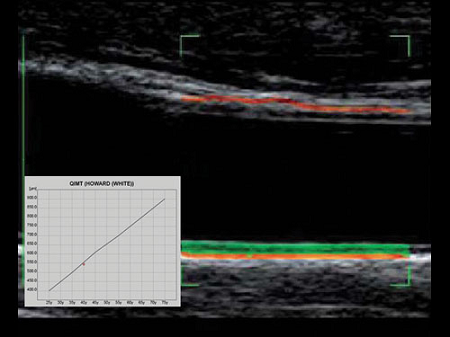 Клиническое изображение – MyLab™ClassC – толщина интима-медиа (технология RF-QIMT)
