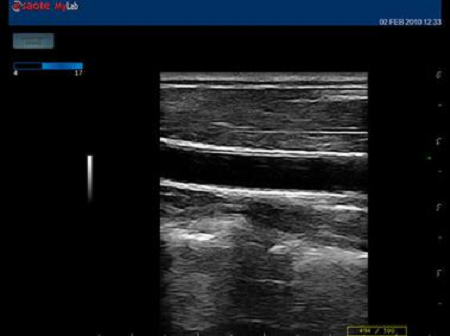 Клинические изображения – MyLab™One – сонная артерия – продольноая визуализация