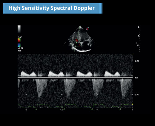 Спектральный Допплер Высокой Чувствительности: Умеренная регургитация Трикуспидального Клапана - Доплеровский сигнал CW