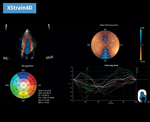 XStrain4D: технология отслеживания спеклов, которая обеспечивает объемную модель работы сердца