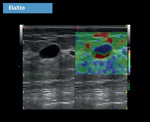 ElaXto: ElaXto-это неинвазивный метод, который помогает врачу оценить эластичность тканей