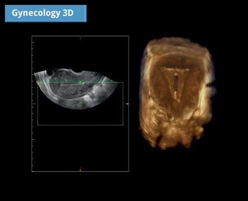 Гинекология 3D: Превосходное 2D-изображение и идеальный рендеринг 3D-реконструкции