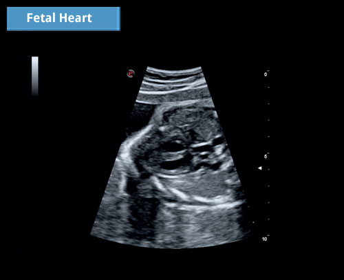 Сердце плода: изображение с высоким разрешением, позволяющее визуализировать любые конкретные детали