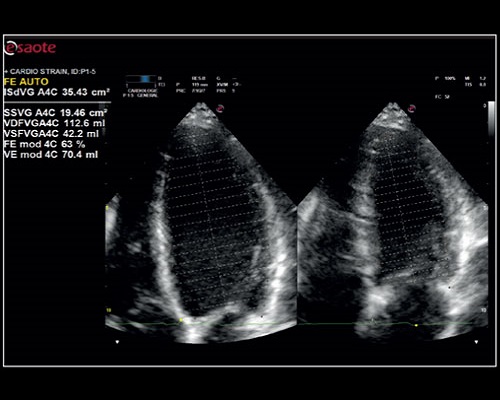 Измерение EF с нулевым кликом сердца с маткой - АВтоэф для исследования
