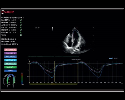 Оценка деформации сердца с нулевым щелчком мыши с помощью XStrain™2D