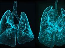 Трёхмерный рентген для диагностики заболеваний лёгких